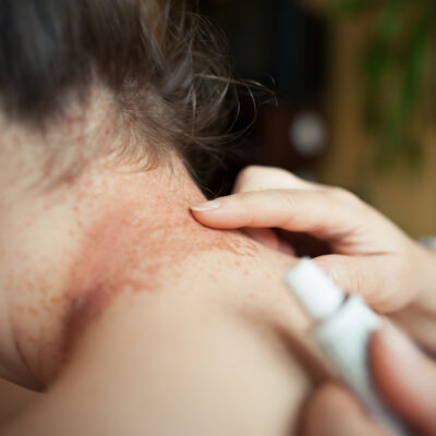 Treating Eczema vs. Atopic Dermatitis